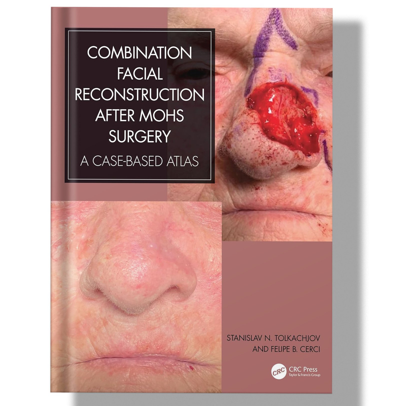Combination Facial Reconstruction after Mohs Surgery: A Case Based Atlas 1st Edition